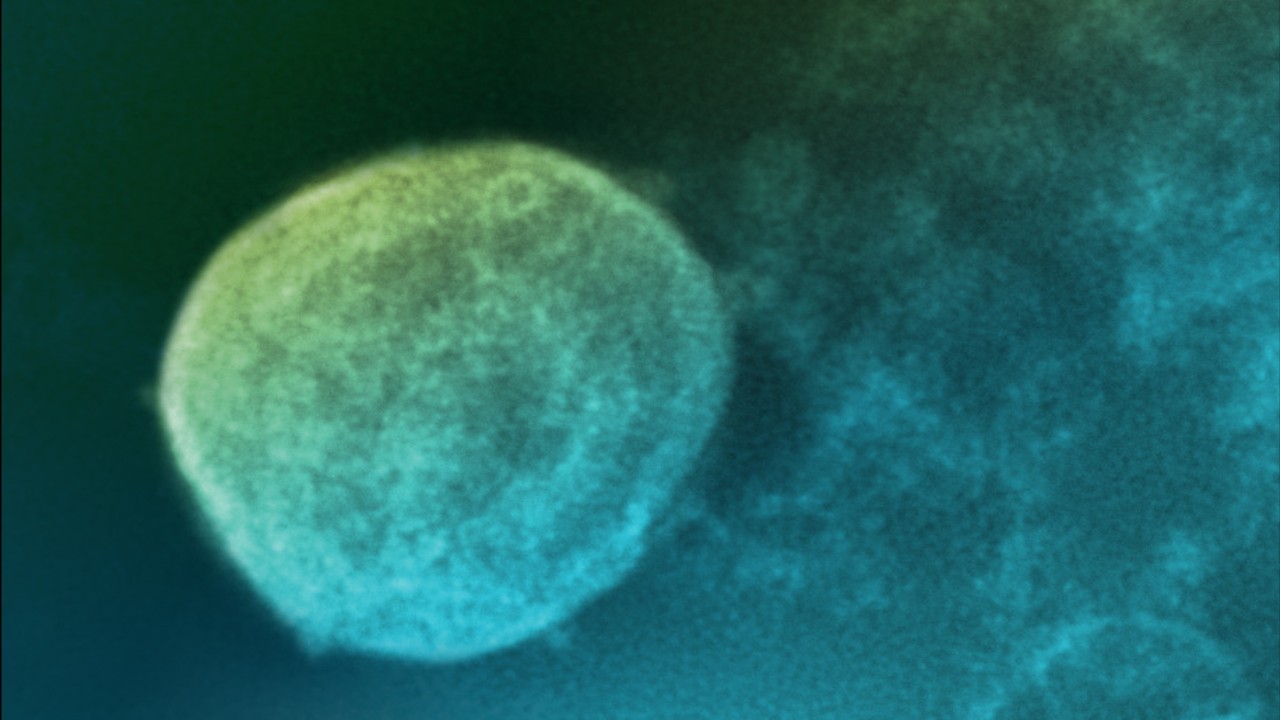 În India a fost declarată stare de alertă: au fost confirmate cinci cazuri de infectare cu virusul mortal Nipah în apropierea orașului Calcutta.