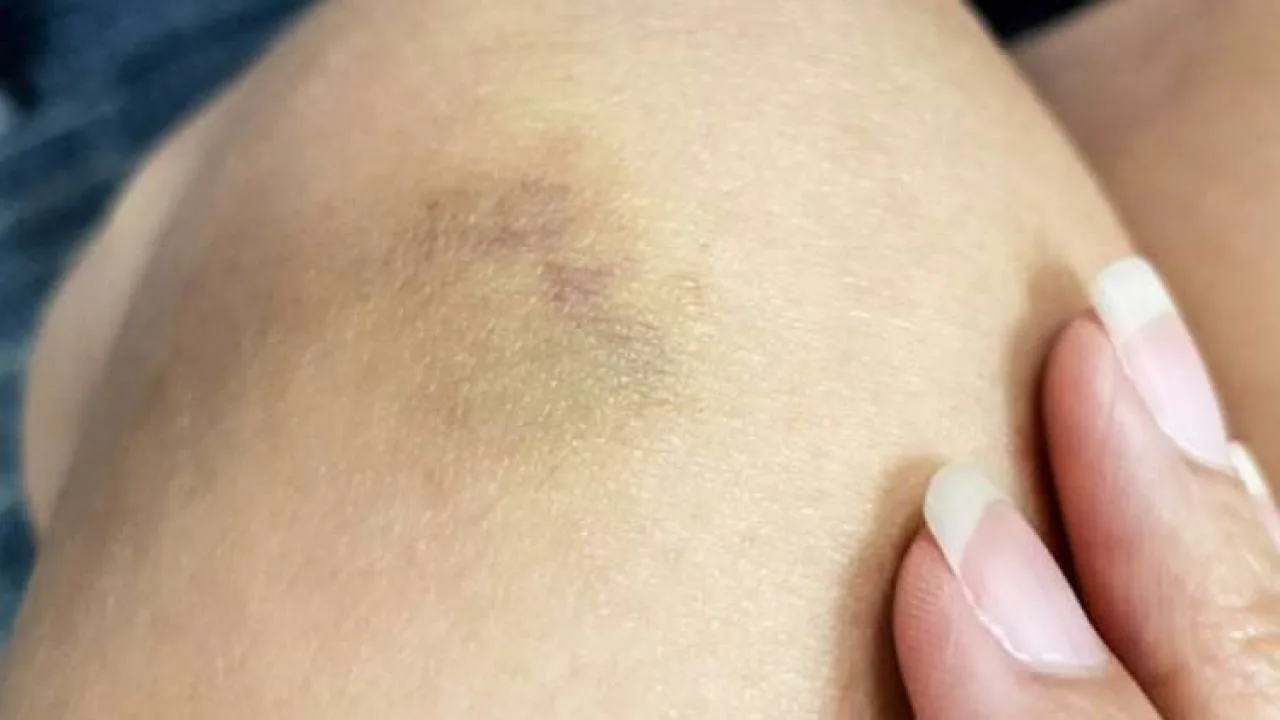 De ce vânătăile frecvente pot indica un deficit de vitamina C