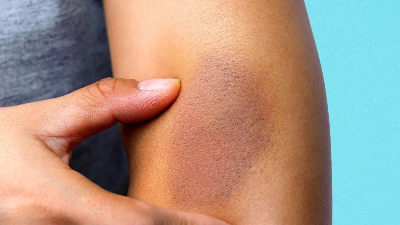 De ce vânătăile frecvente pot indica un deficit de vitamina C